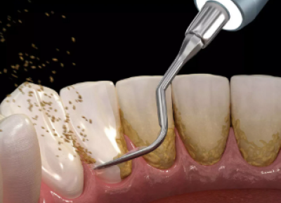 Diş Taşı Temizliği (Detertraj) ve Diş Eti Tedavisi