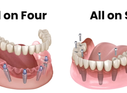 All-on-4 ve All-on-6 İmplant Sistemleri (Tam Çene Restorasyonu)