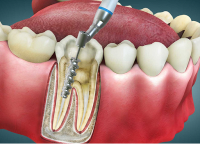 Kanal Tedavisi (Endodonti)